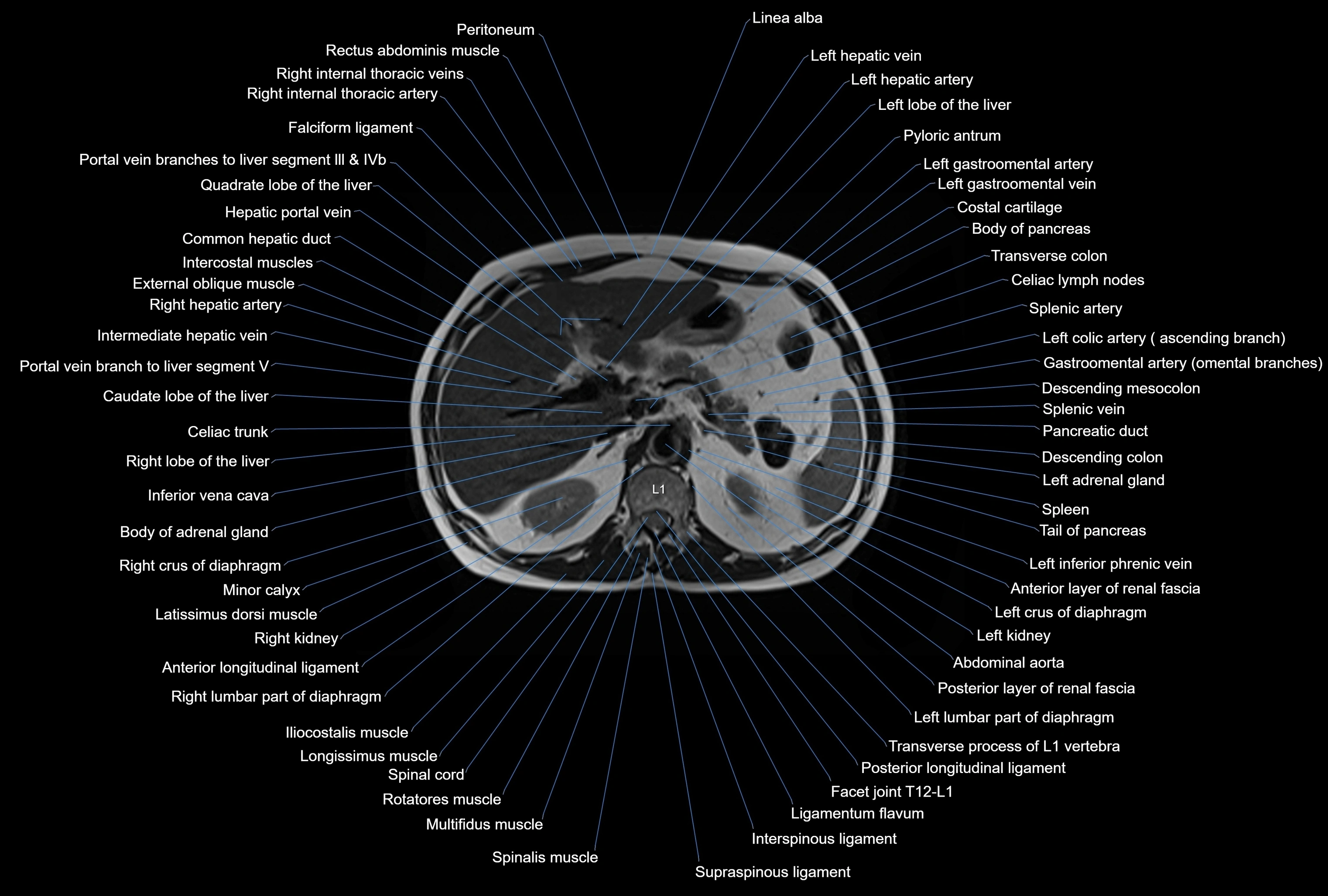 MRI Abdomen axial cross sectional anatomy radiology  image-img-00001-00015.webp